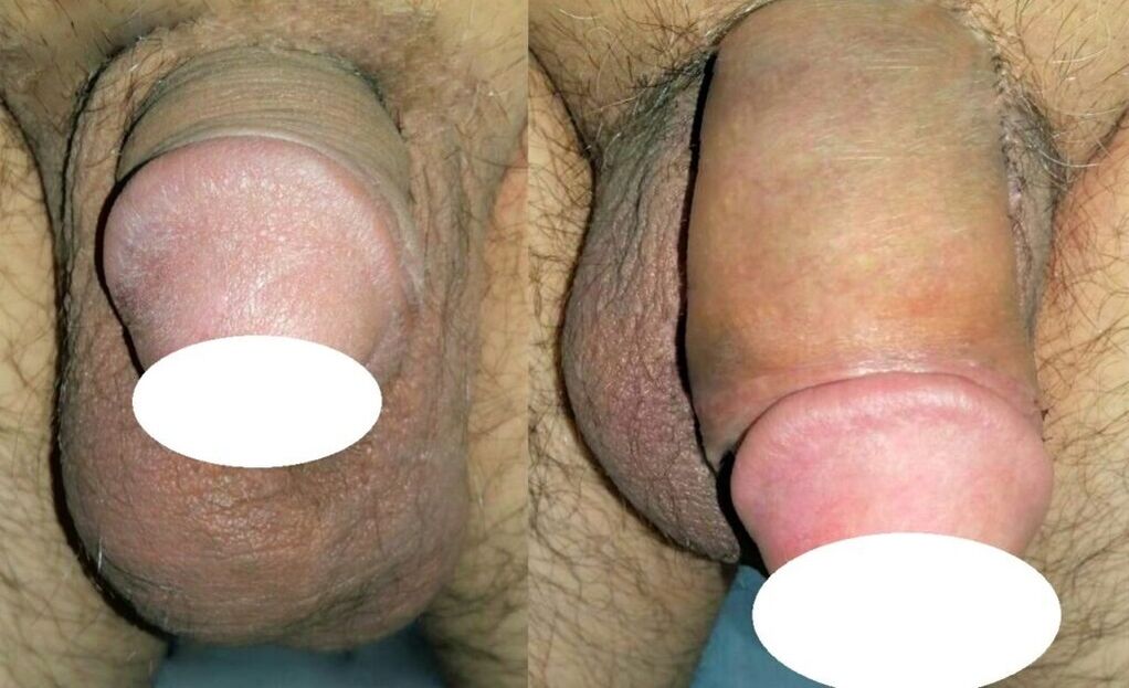 Fotos antes e despois da ampliación do pene
